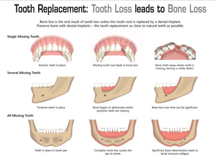 How Dental Implants Stop Jaw Bone Loss