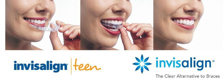 Invisalign Cost In Gurgaon Center For Dental Implants And Esthetics