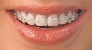 Dental Braces Treatment in Delhi NCR  Orthodontic Treatment Wires and  Braces Delhi