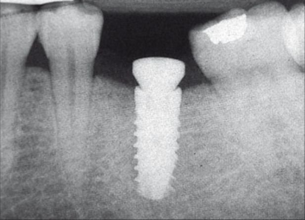 IOPA Dental Xray
