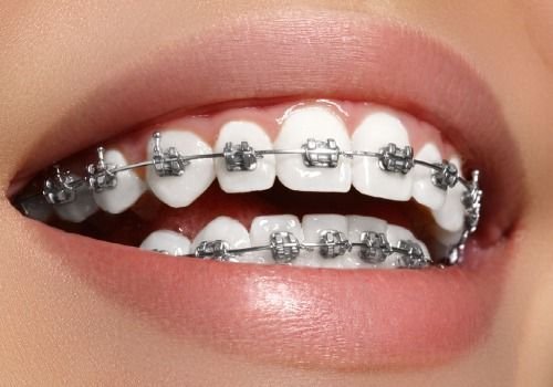 3m metal braces cost