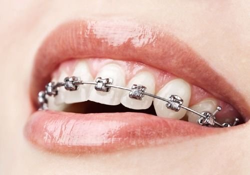 Self ligating braces cost 