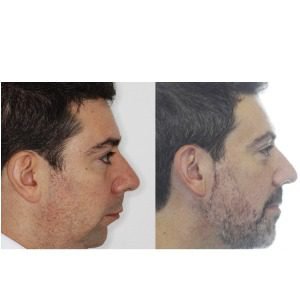 Jaw Alignment Surgery