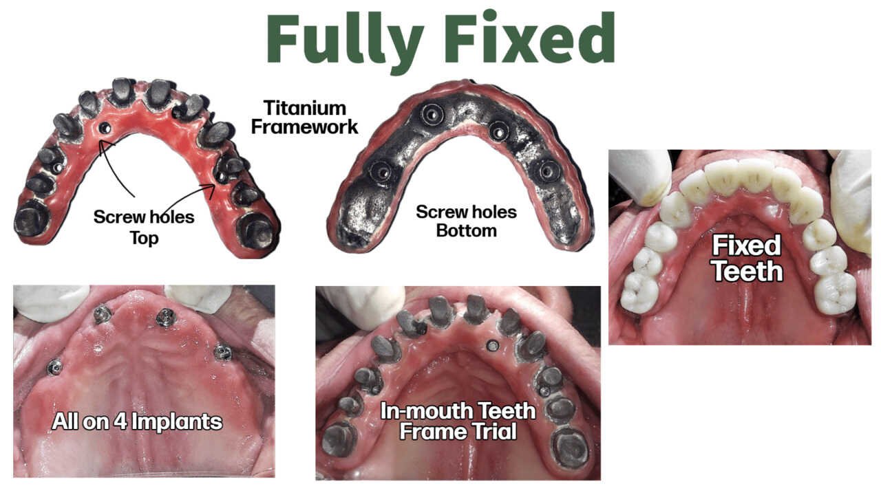 Full Mouth Implant Cost
