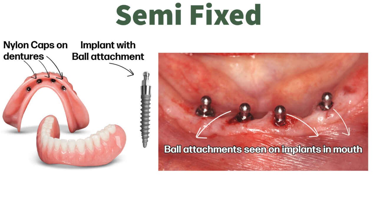 Denture Supported on Implants