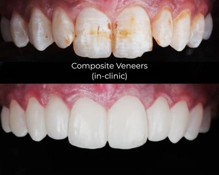 Composite Veneers in Clinic