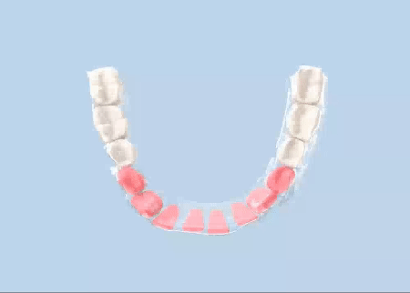 Teeth Aligner Cost in India