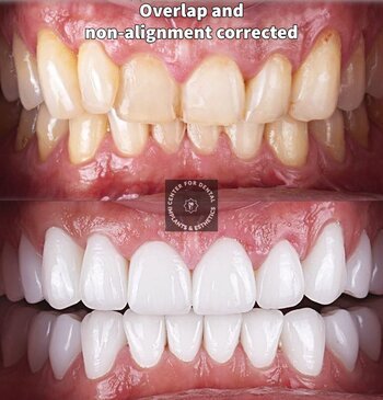 Teeth Alignment with Veneers