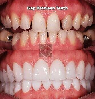 Veneer for closing teeth gap