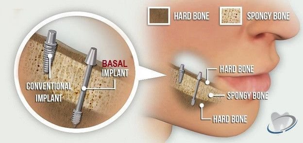 Avoid Basal Implants