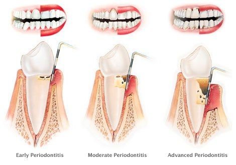 periodontitis