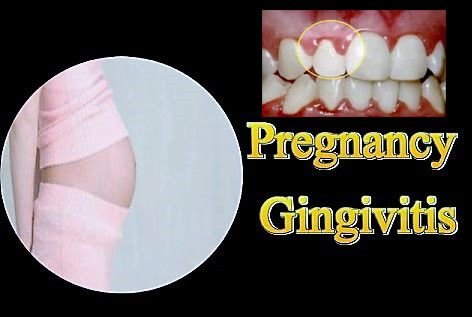 pregnancy gingivitis