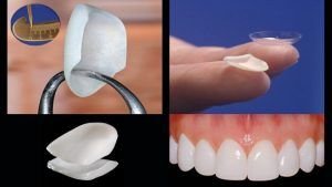 smile makeover with porcelain veneers