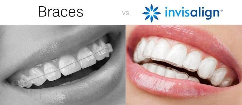 What are Invisalign Pros & Cons?