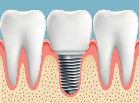 Dental Implants in Gurugram