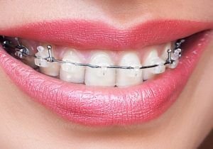 Dental Braces in Gurugram