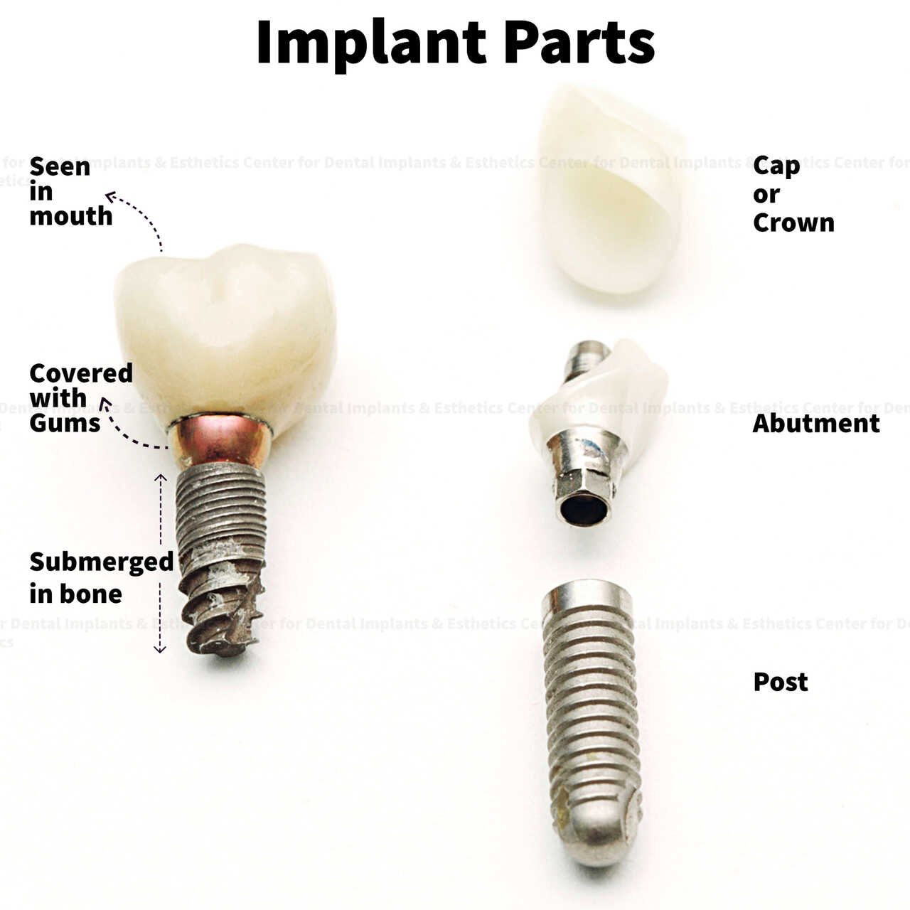 How Dental Implants Work