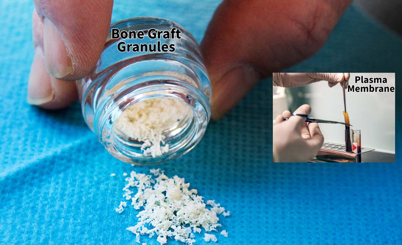 Bone graft for dental implants — bone loss vs grafted bone diagram