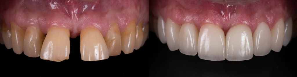 Composite Dental Laminate