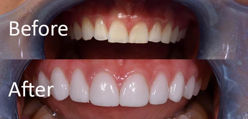 Dental ceramic veneer material quality comparison at prosthodontist clinic in Gurgaon