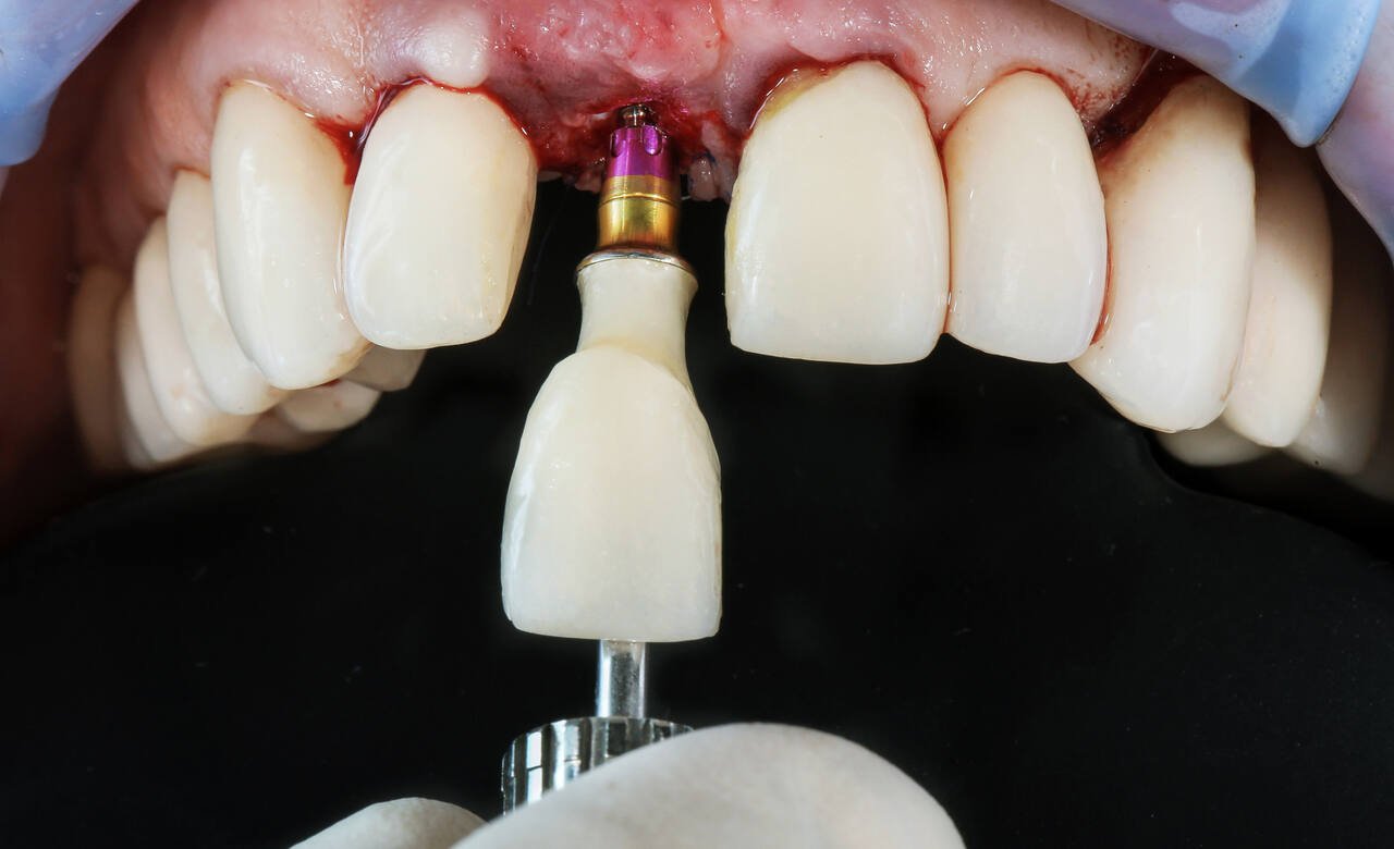 Front tooth implant result compared to molar implant result - CDIE Gurgaon