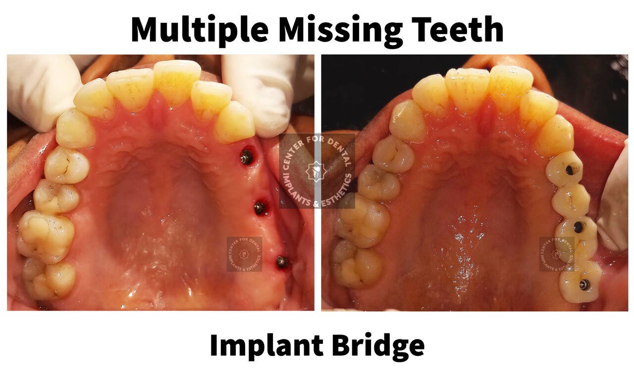 Fixed Implant Supported Bridge in Gurgaon