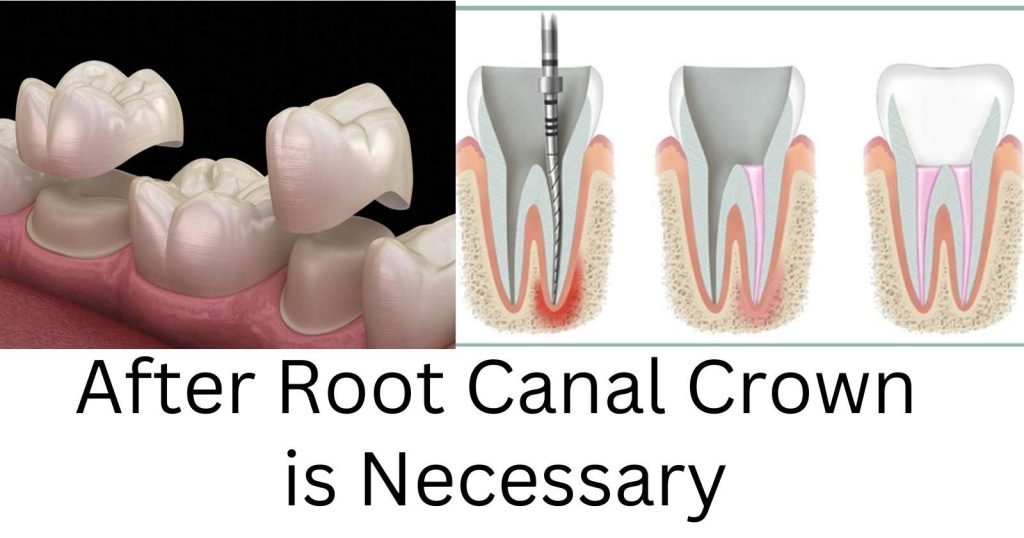 crown after root canal