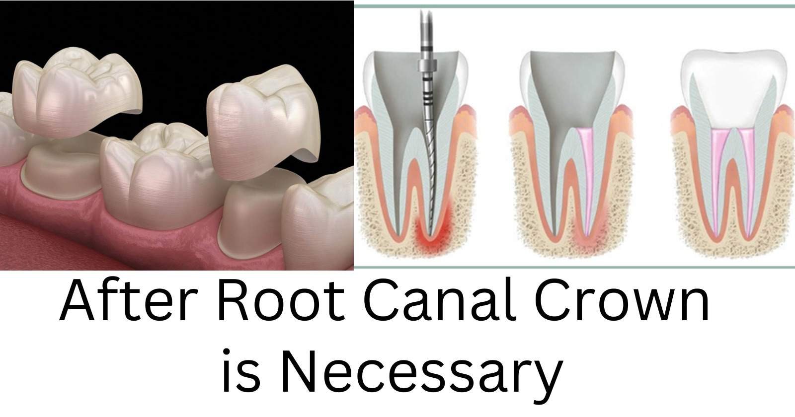 root canal crown