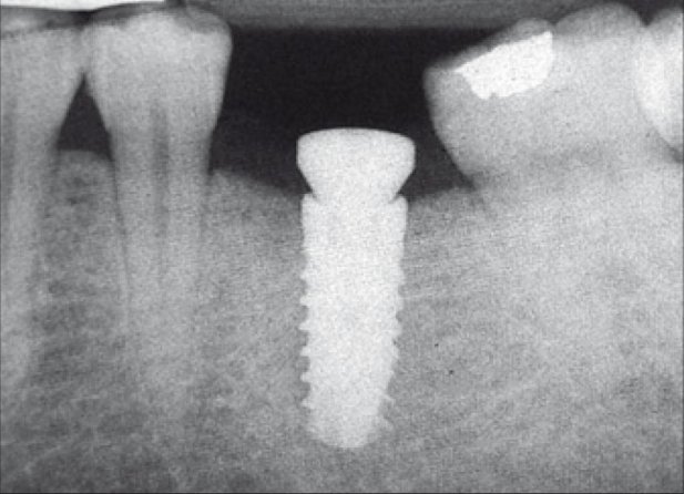 All you wanted to know about dental implants