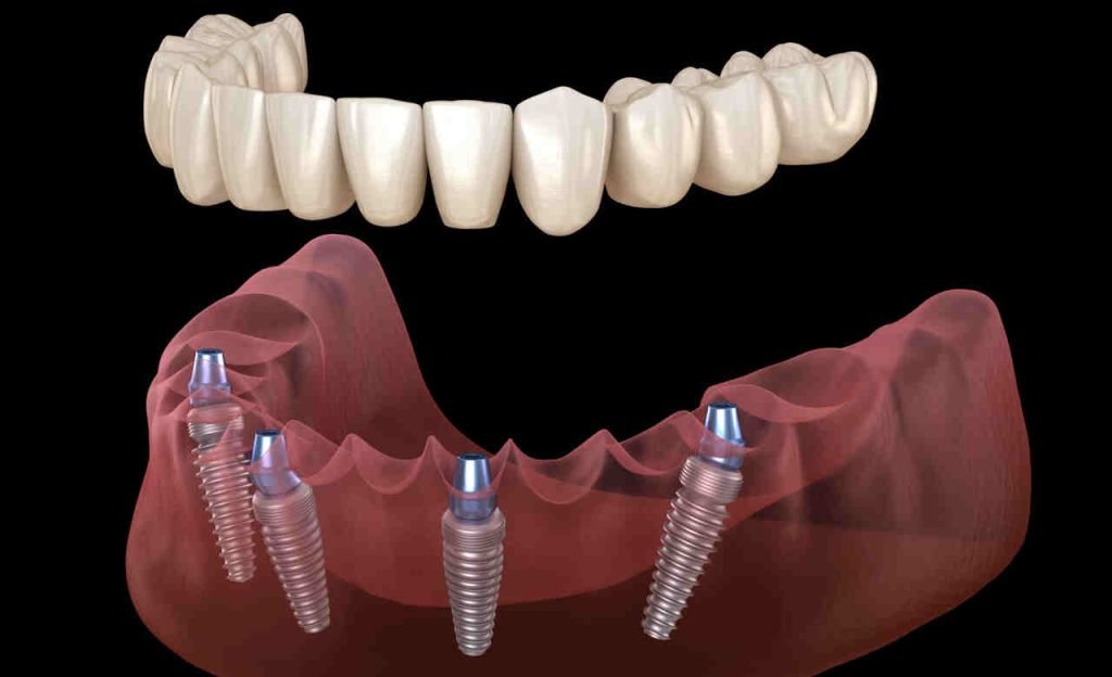 Straumann Implants :: Center for Dental Implants & Esthetics @ [Center ...