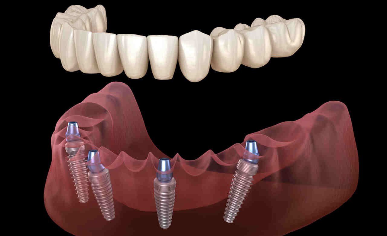 Gum Surgery : Procedure & Cost in India 🦷