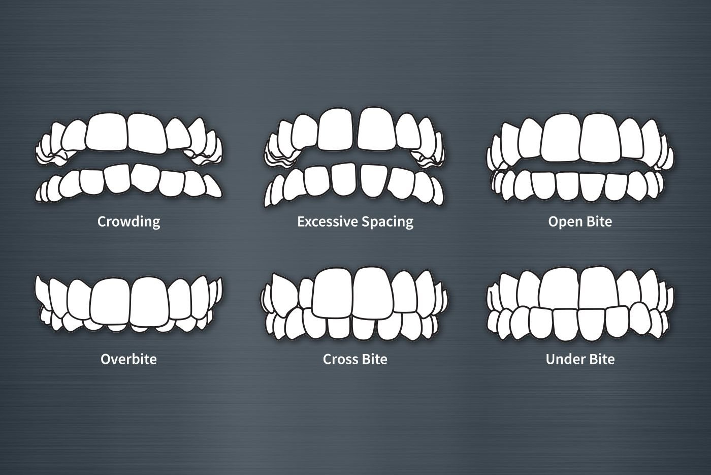 bite-correction-with-braces-affordable-acccurate