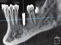 Dental Implants with Bone Loss 