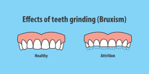 Bruxism Treatment : Natural Remedies and Causes