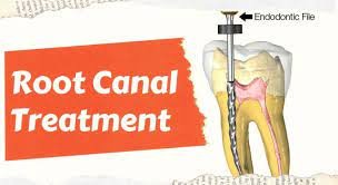  Disadvantages of Root Canal Treatment