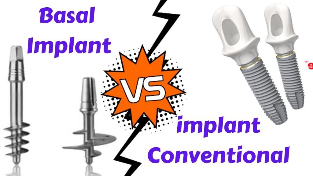 Single Piece Implants vs Two Piece Implants
