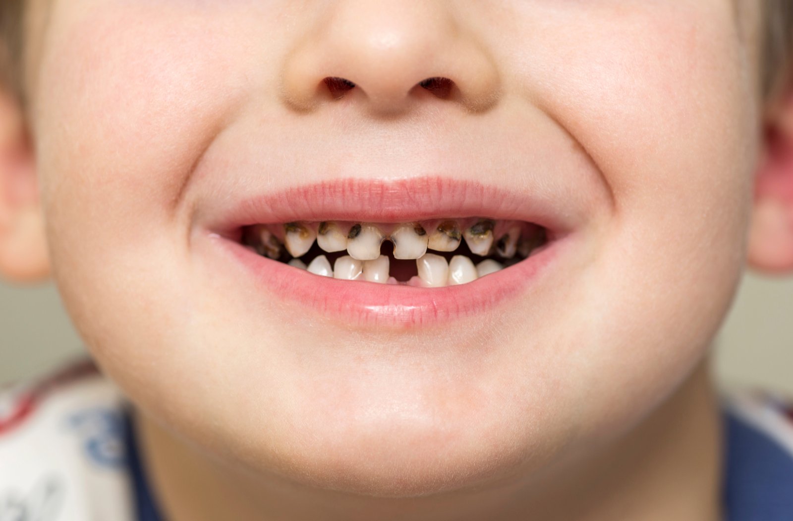 Preventing Tooth Decay In Kids