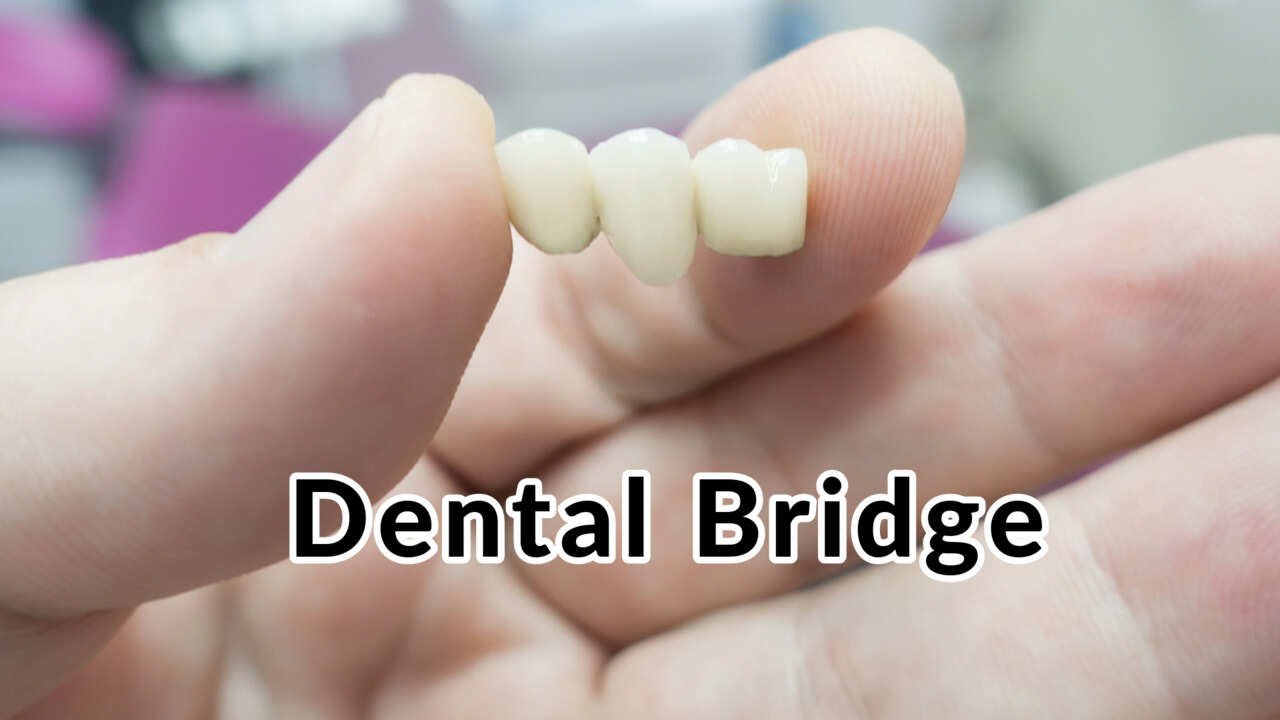 Dental Bridge - [Types, Cost, Benefits & Risks]