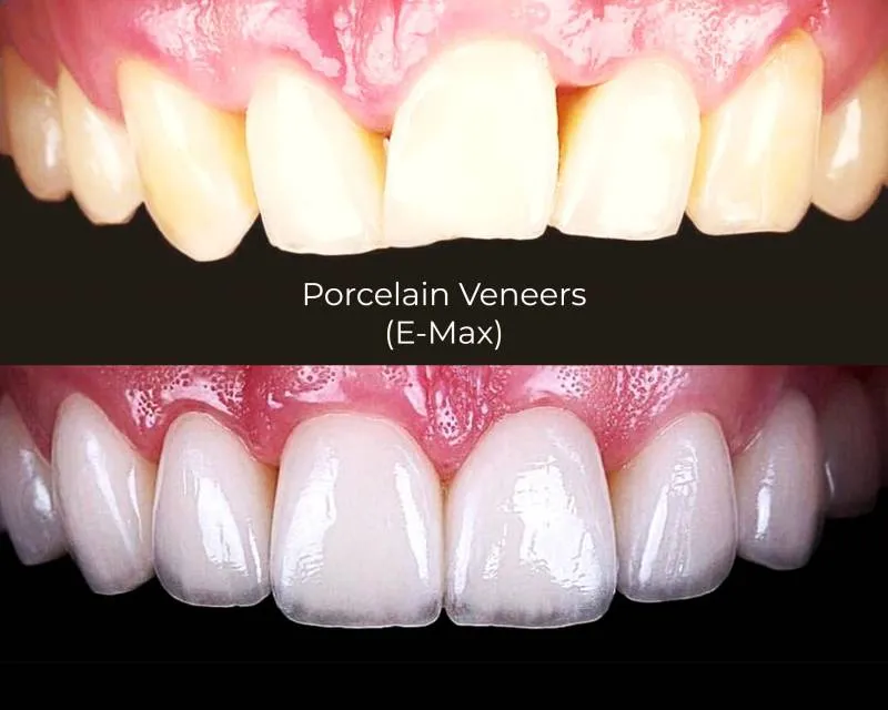 Porcelain E-max veneers for fluorosis treatment — natural result at Center for Dental Implants Esthetics Gurgaon