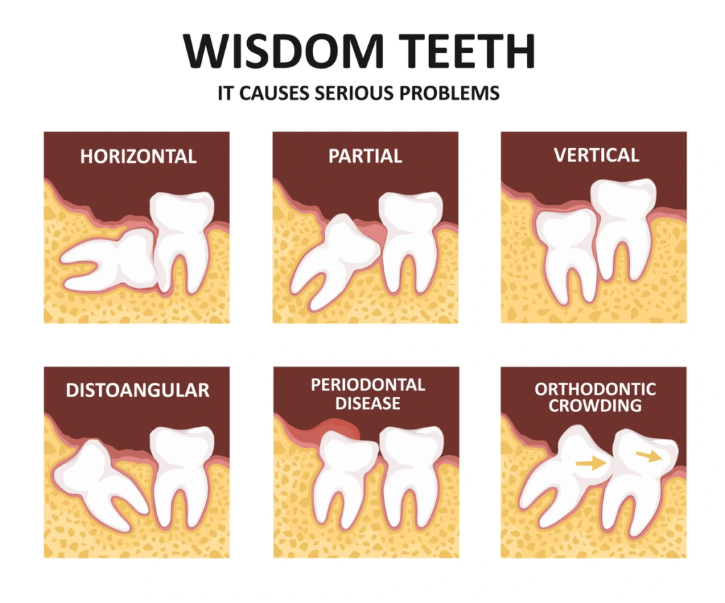 Wisdom Tooth Impaction Types