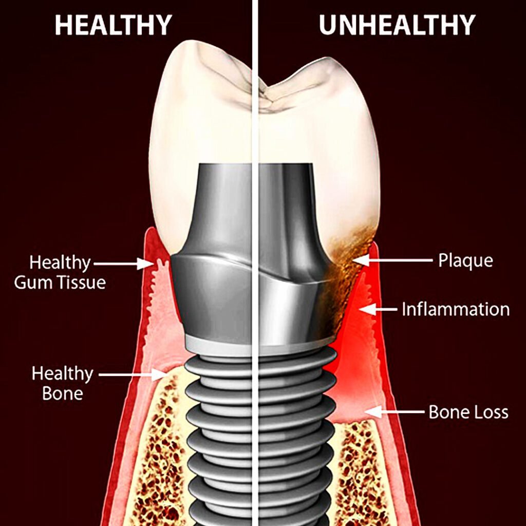 Peri-Implantitis