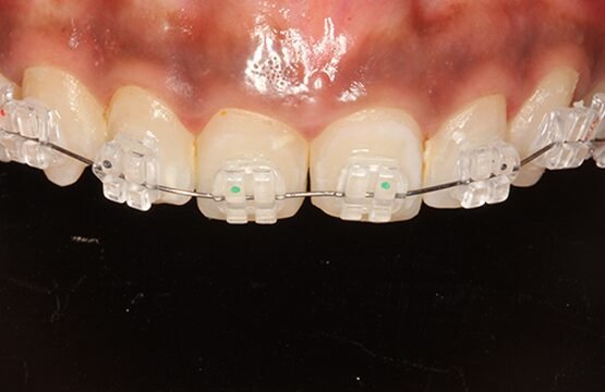 Ceramic Self ligating Braces Cost