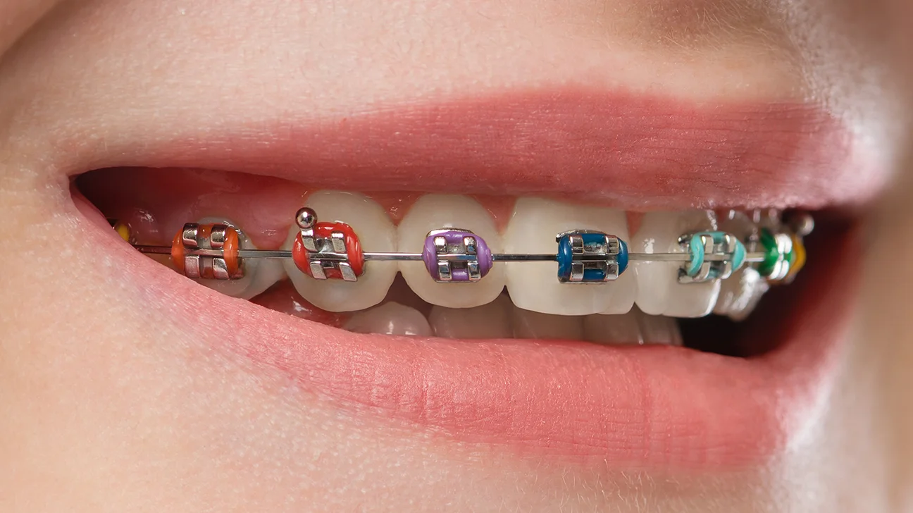 Metal Braces Cost