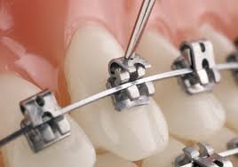 Self ligating Braces Cost