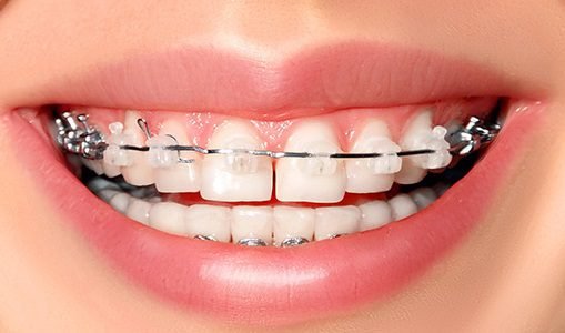 Ceramic Braces Cost