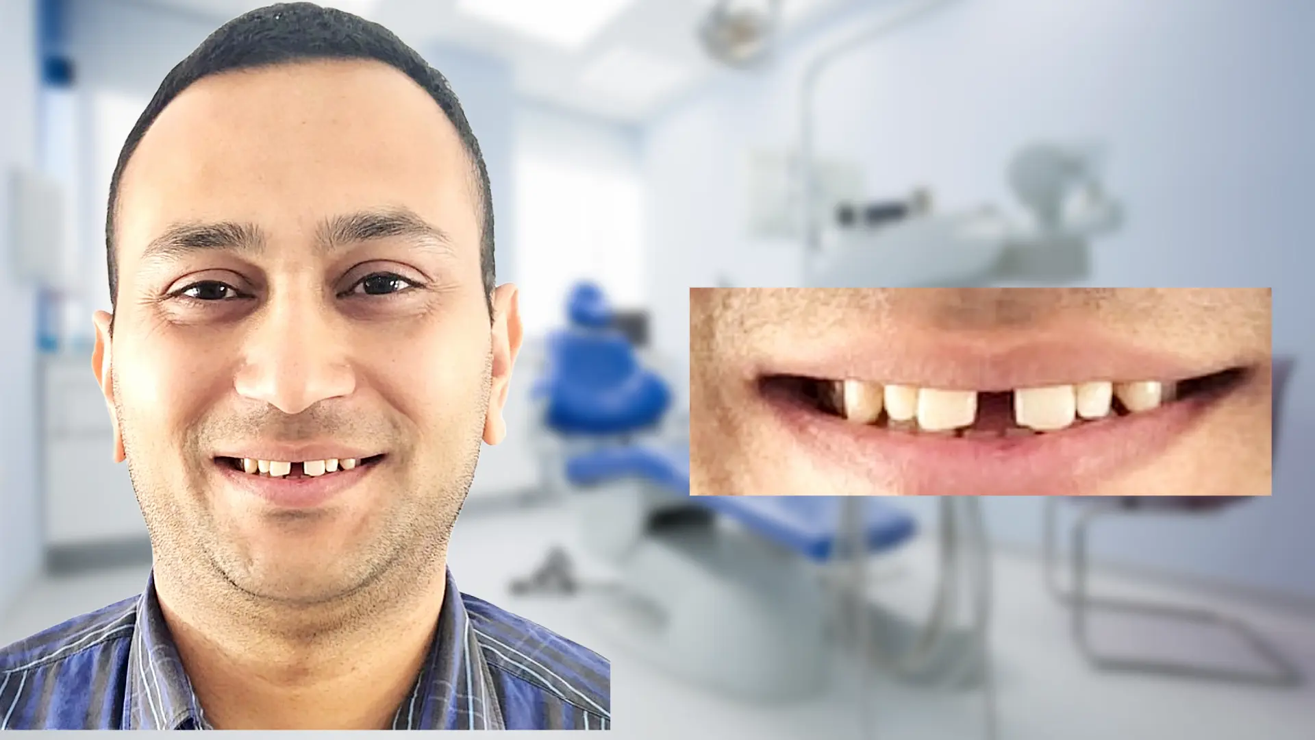 Before treatment - gap between teeth