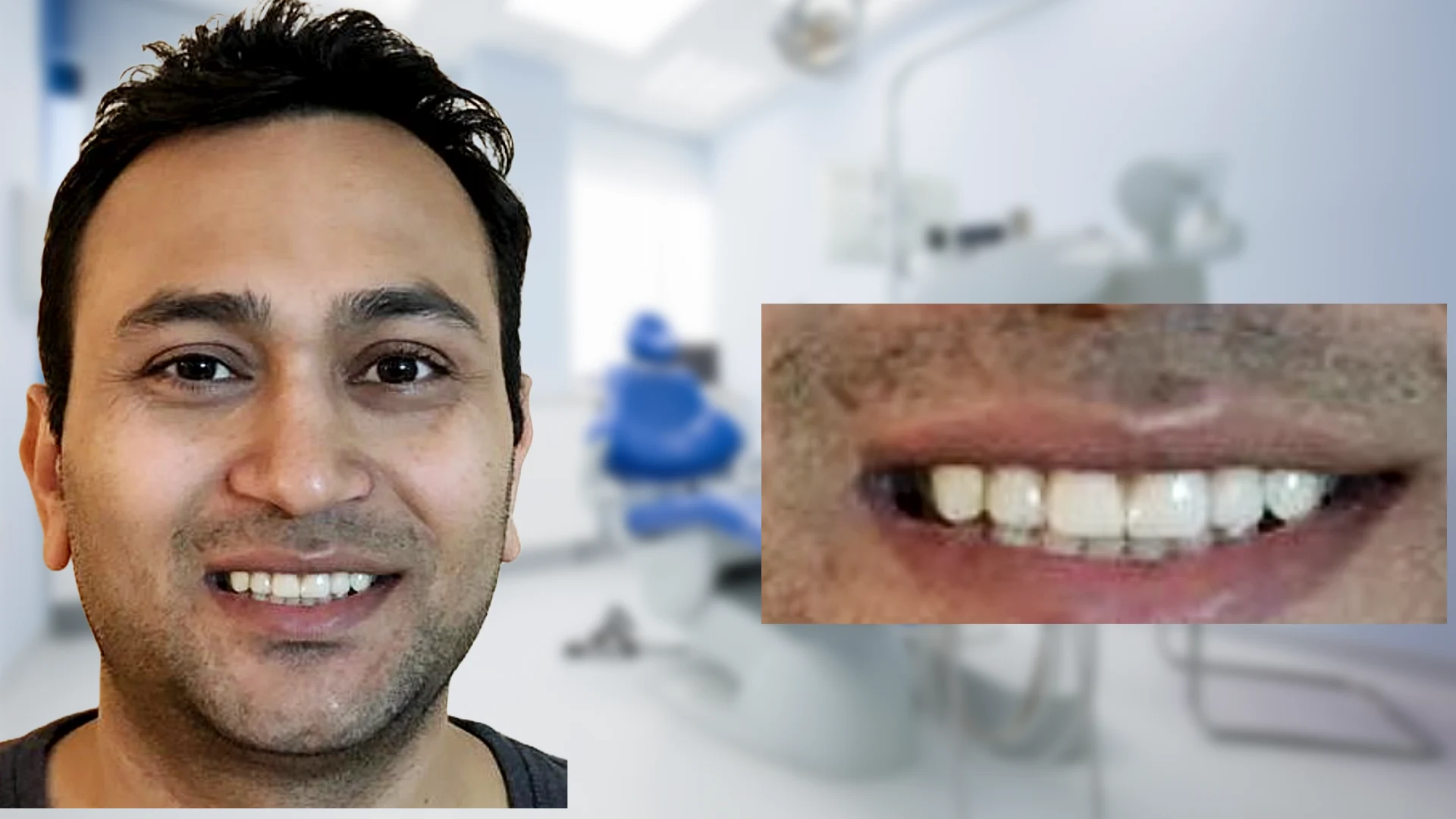 After treatment -Gap in teeth gone