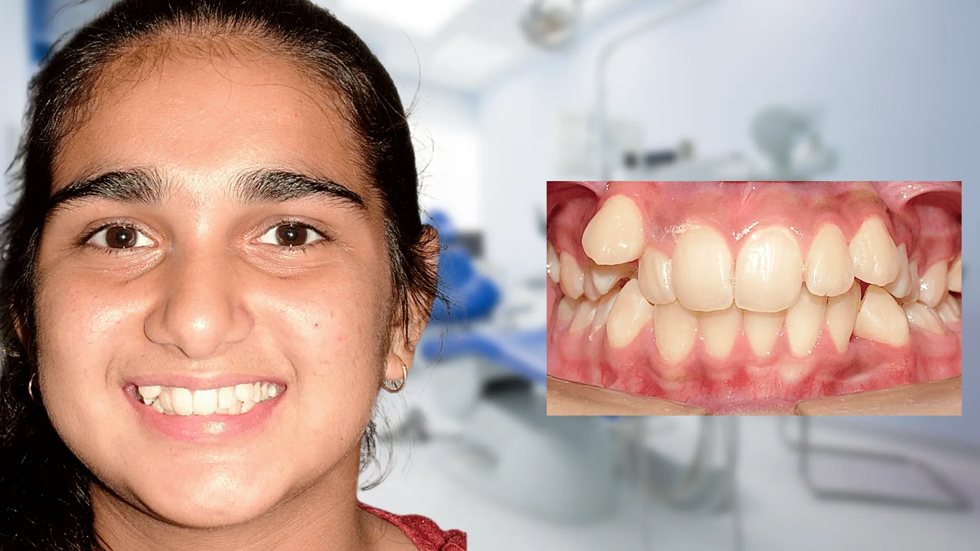 Before treatment - crooked teeth
