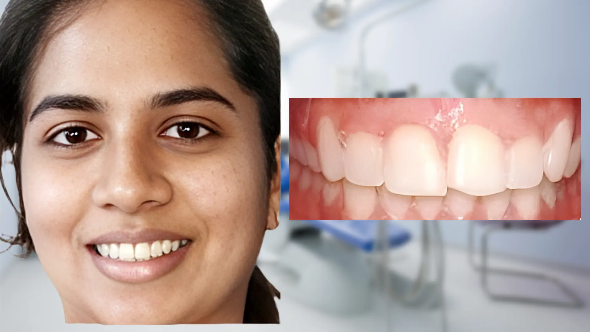 After treatment - Bite Corrected