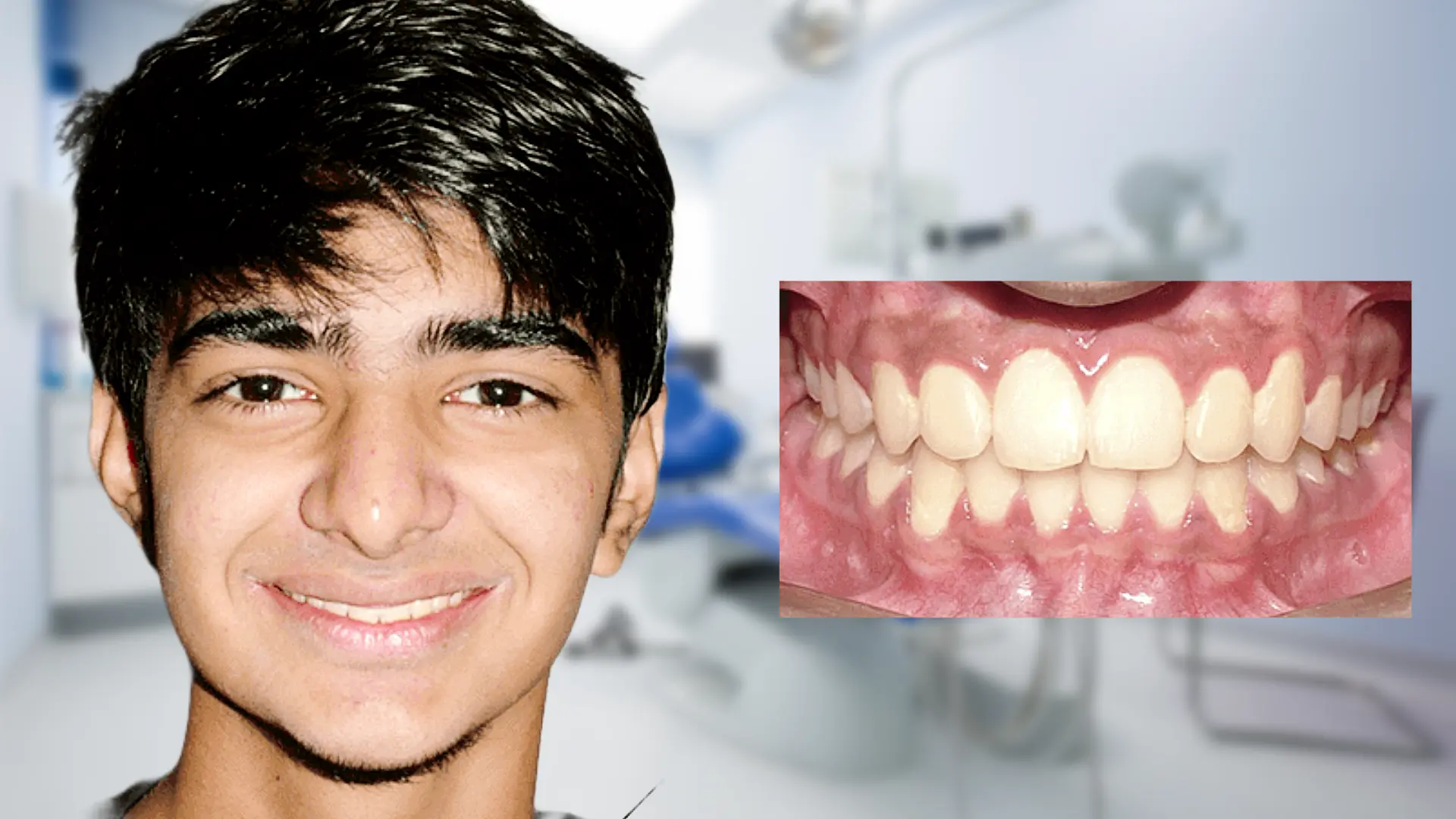After treatment - corrected bite